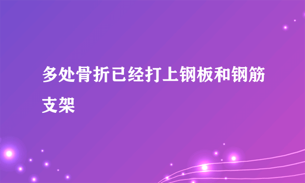 多处骨折已经打上钢板和钢筋支架