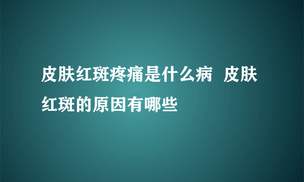 皮肤红斑疼痛是什么病  皮肤红斑的原因有哪些