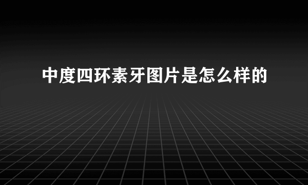 中度四环素牙图片是怎么样的