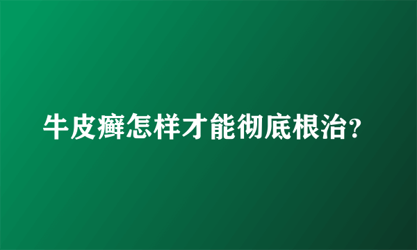 牛皮癣怎样才能彻底根治？