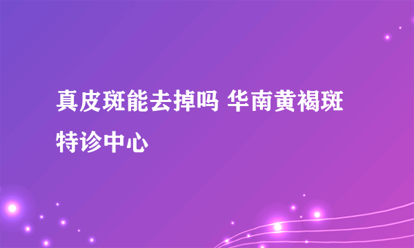 真皮斑能去掉吗 华南黄褐斑特诊中心