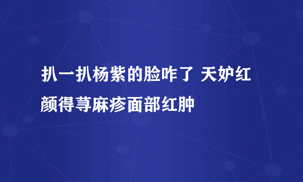 扒一扒杨紫的脸咋了 天妒红颜得荨麻疹面部红肿