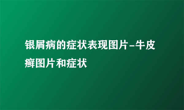 银屑病的症状表现图片-牛皮癣图片和症状