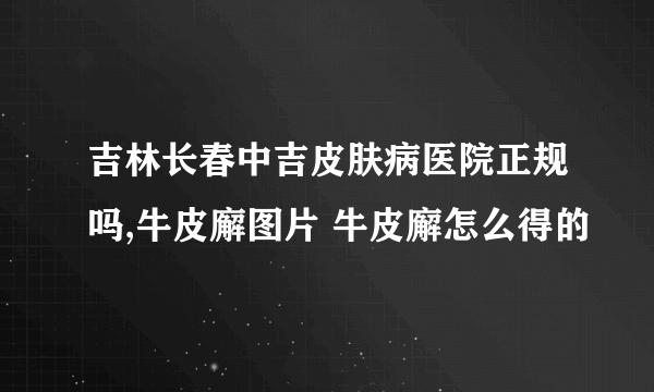 吉林长春中吉皮肤病医院正规吗,牛皮廨图片 牛皮廨怎么得的