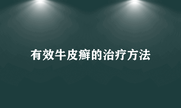 有效牛皮癣的治疗方法